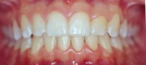 Casos Clínicos-Egos Clínica Odontológica-Curitiba-Implantes_Dr Eurides_dentista_curitiba_Eurides Gurkewicz_Valeria_02